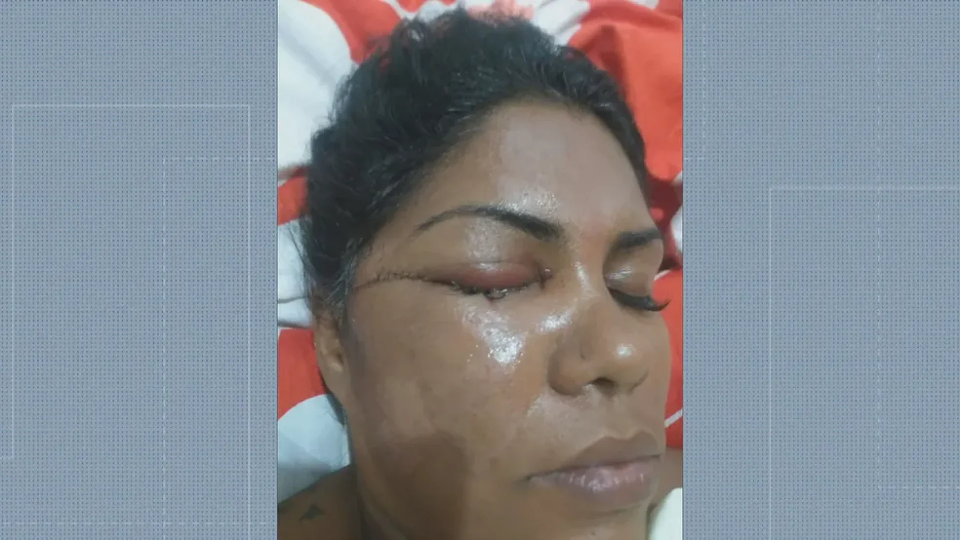 Bruna Vaz perdeu a visão do olho direito após ser atacada — Foto: Reprodução/TV Globo